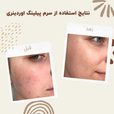 سرم پیلینگ اوردینری ۳۰ میلی لیتر